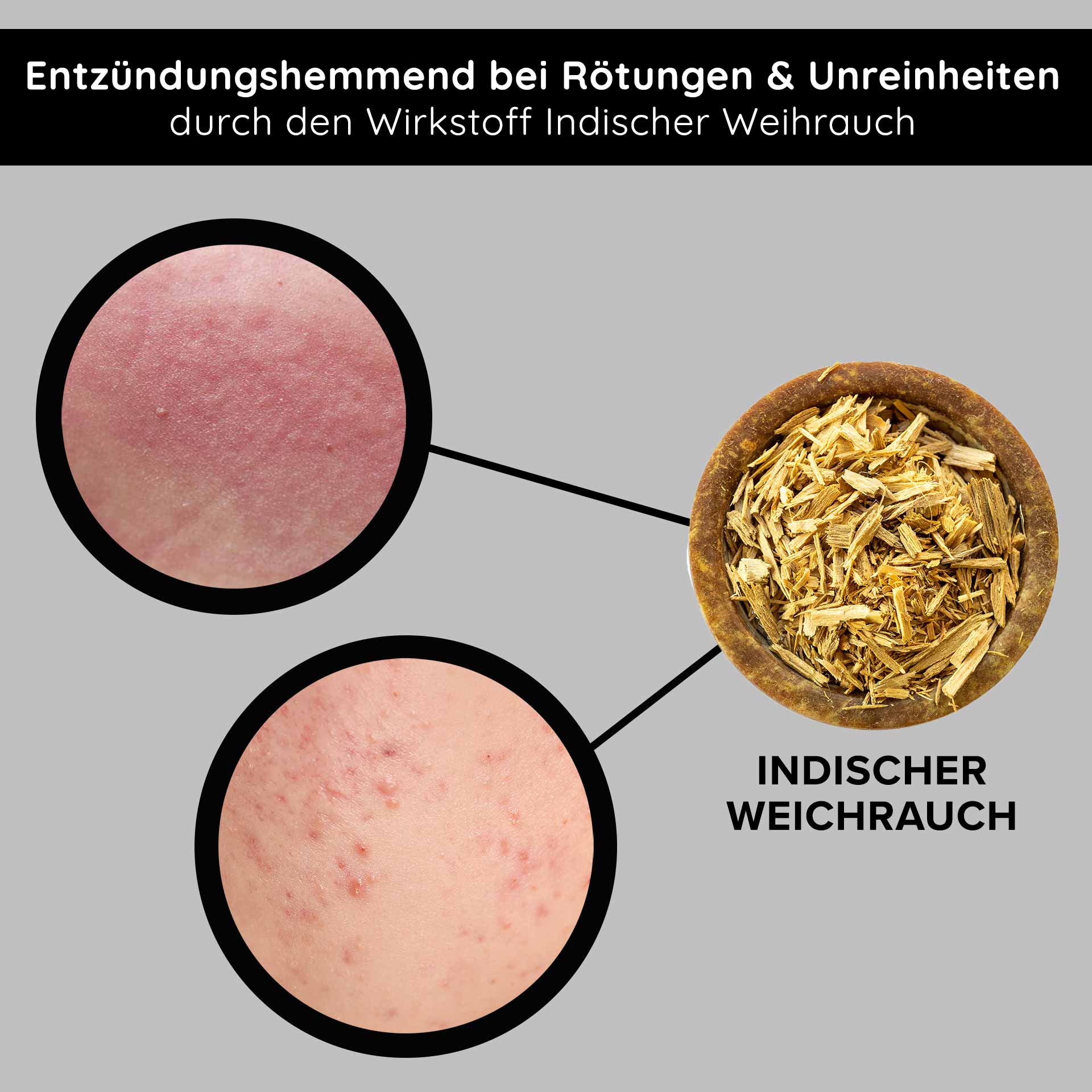 Tri-Peeling 50 毫升 酵素和果酸去角质产品 Entzündungshemmendes Indischer Weihrauch zur Reduzierung von Rötungen und Unreinheiten, mit Nahaufnahmen von betroffener Haut.