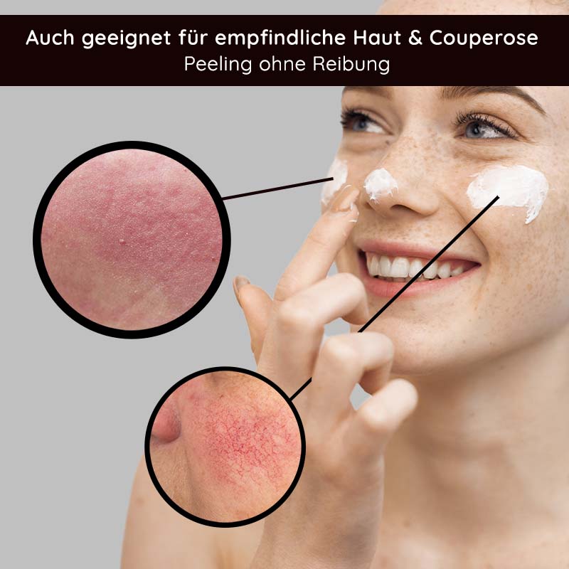 果酸去角质 100 毫升 含 BHA 的果酸去角质产品 Frau mit fröhlichem Gesicht, die Fruchtsäurepeeling auf die Haut aufträgt, um empfindliche Haut und Couperose zu behandeln, mit Nahaufnahmen von geröteter Haut und Peelingeffekten.