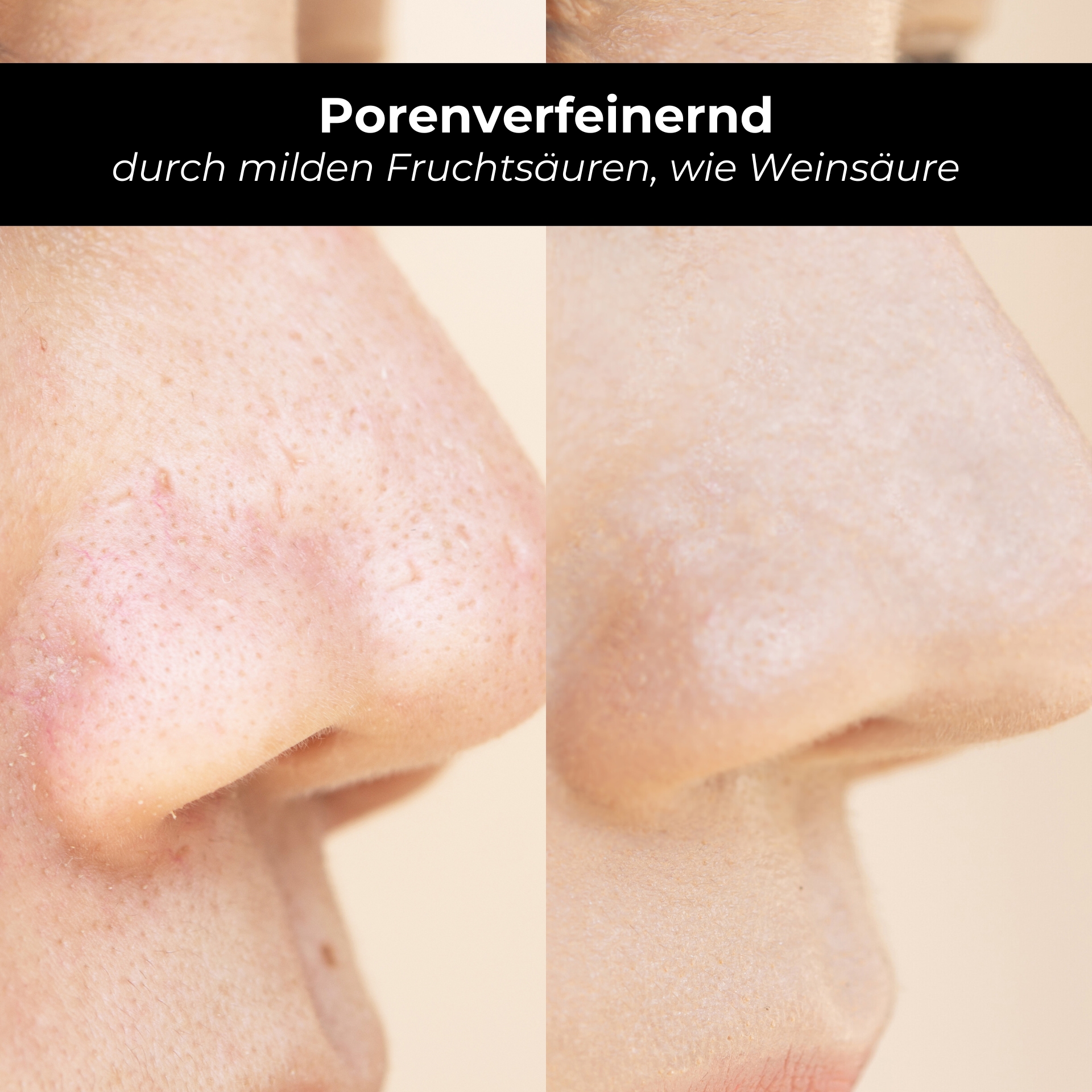 RAU AHA Tonic 50 ml - 含温和果酸的清爽滋补品 Porenverfeinerndes Hautbild durch milde Fruchtsäuren, wie Weinsäure, vor und nach Anwendung des RAU AHA Tonic.